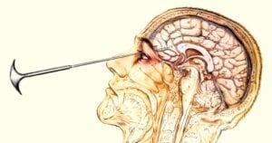 20 Medical Practices from History That Are Absolutely Bizarre